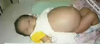 “Pregnant” Baby Boy in Parasitic Foetus Phenomenon 