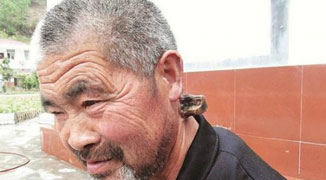 Elderly Hubei Man has Horn Growing out of his Neck
