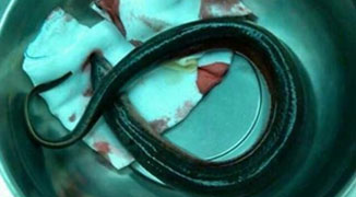 Guangdong Man Has Live Eel Pulled From Intestines